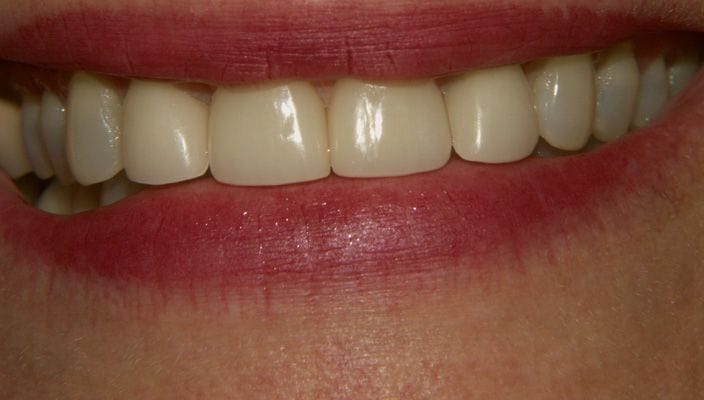 Hairline Cracks In Front Teeth